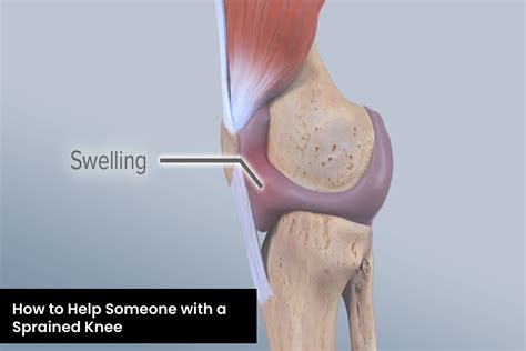 How to Help Someone with a Sprained Knee - Health Upp