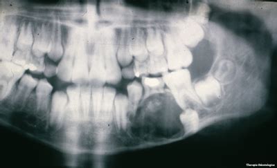 Calcifying Odontogenic Cyst Radiographic