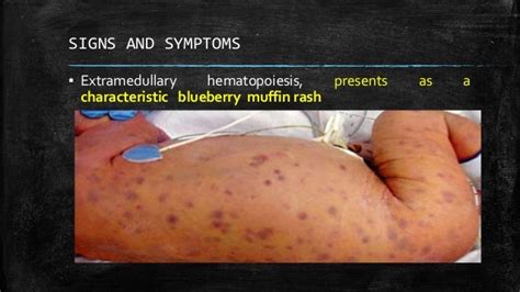 CONGENITAL RUBELLA SYNDROME