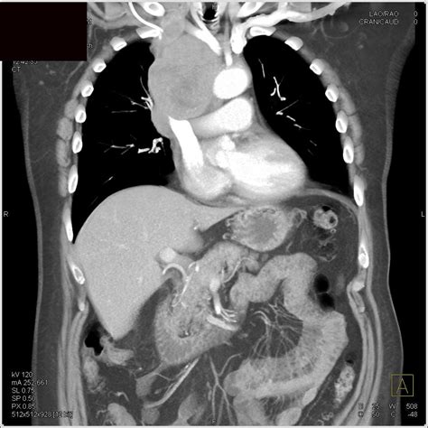 Lymphoma with Extensive Mediastinal Adenopathy - Chest Case Studies - CTisus CT Scanning