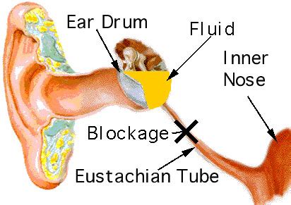 Glue Ear in Children | Healthcare-Online