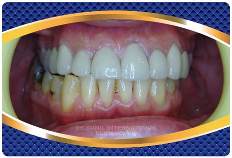 Before After - Porcelain Crown / Bridges in Bangkok, Thailand at Dr. Sunil Dental Clinic