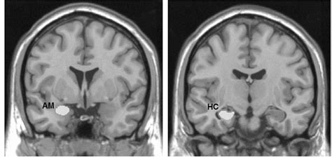 Volume determination of amygdala and hippocampus at 1.5 and 3.0T MRI in temporal lobe epilepsy ...