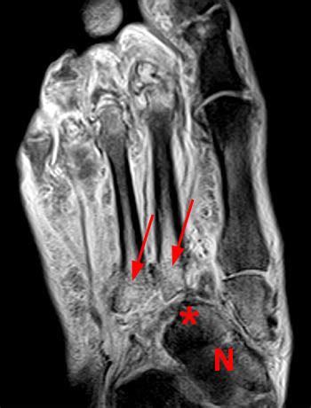 Foot Muscles Mri / MRI IN FOOT PAIN - tohtoha