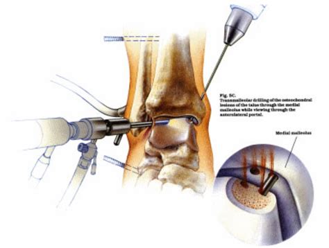 Anterior Arthroscopy | Peter Rosenfeld FRCS, London