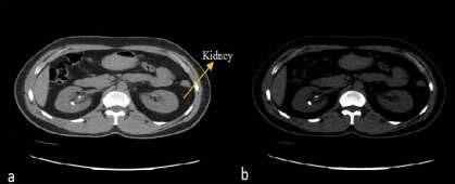 Abdominal CT scan image (a) Image after contrast adjustment (b) Another ...