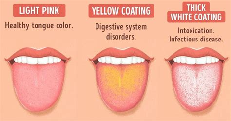 What Your Tongue Can Tell You About Your Health | Breckenridge Dental