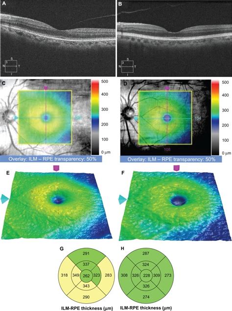 File:OCT OD Retinal Thickness Wikipedia, 40% OFF