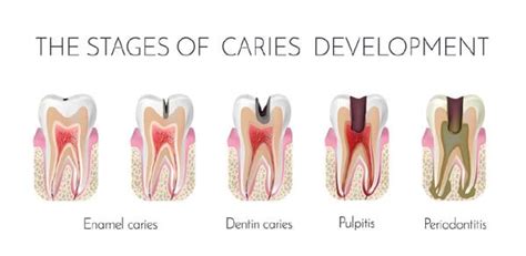 All You Need To Know About Teeth Extractions | The Dental Studio