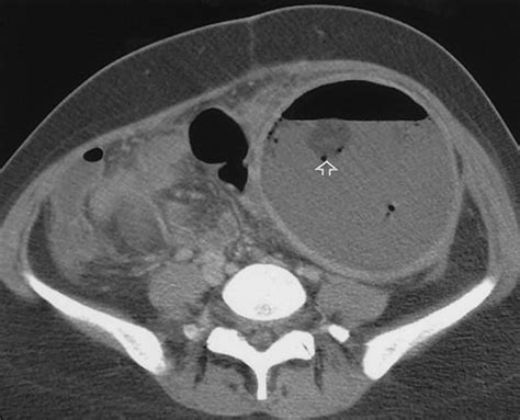 Gynecologic Causes of Acute Pelvic Pain: Spectrum of CT Findings | RadioGraphics