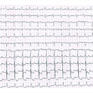 -Electrocardiogram of a patient with alcoholic cardiomyopathy and stage... | Download Scientific ...