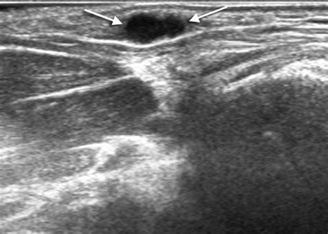 Ultrasonographic Features of Eccrine Spiradenoma - Hwang - 2018 ...