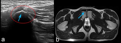 Frontiers | The Case of Insertional Adductor Tendinopathy of an International-Level 3,000-m ...