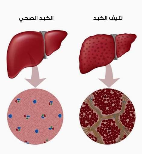 ‫معلومه طبيه التهاب الكبد - Home | Facebook‬