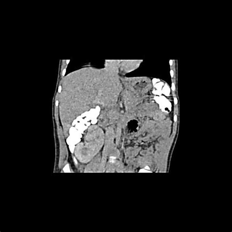 Right kidney malrotation | Radiology Case contributed by Dr Arthur Daire | Radiopaedia.org