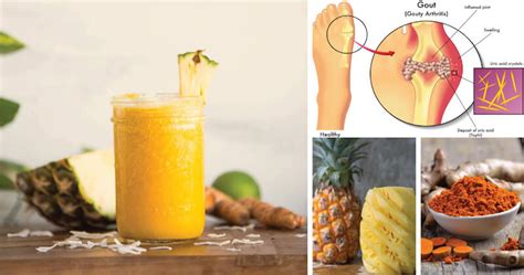 Natural Treatment for Gout in Foot: Get the Remedy