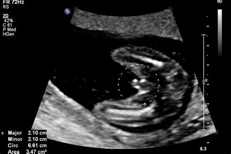 Pregnancy 15 Weeks Ultrasound - Pregnancy Sympthom