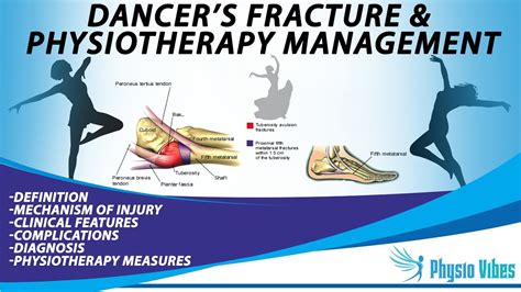 DANCER'S FRACTURE & PHYSIOTHERAPY MANAGEMENT - YouTube