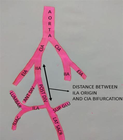 Distance between the bifurcation of CIA and the origin of ILA when ILA ...