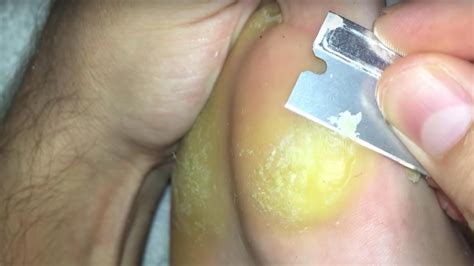 This Foot Callus Removal YouTube Channel Is Equally Disgusting and Satisfying to Watch | Allure