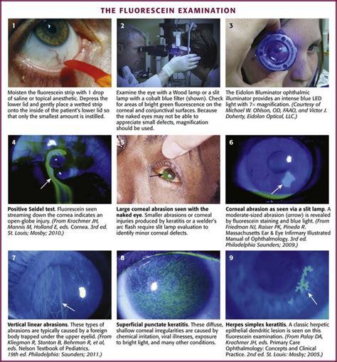 Cpt For Fluorescein Eye Exam – justgoing 2020