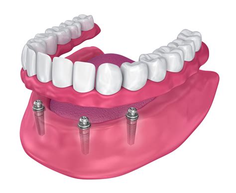 How Many Dental Implants Will I Need for Implant Dentures?