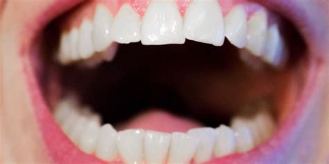 7 Stunning Benefits Of Going Through an Invisalign Treatment