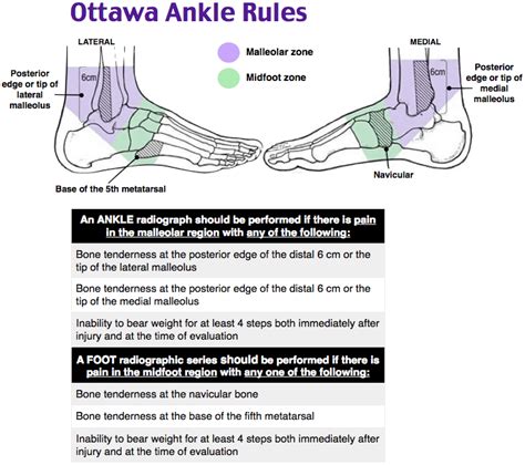 Rapid Review: Ottawa Ankle Rules - RoshReview.com