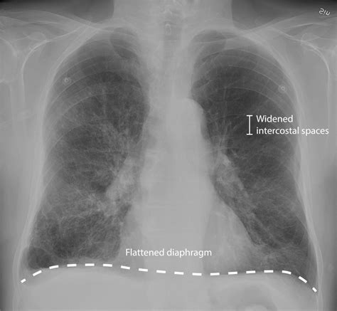 Chronic Obstructive Pulmonary Disease X Ray