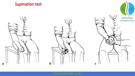 Radial Nerve Palsy Test | OrthoFixar 2024