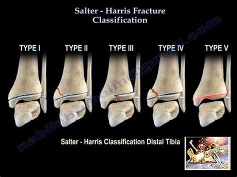 Salter Harris Tibial Fracture