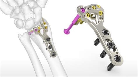 Acu-Loc 2 Wrist Plating System | Acumed