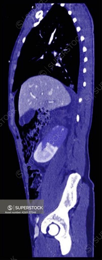 Renal infarct. Oblique sagittal Compted Tomography (CT) scan of the the ...