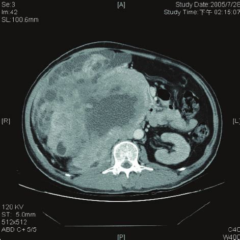 Contrast computed tomography demonstrated a right-side | Download Scientific Diagram