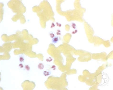 Leukocyte Alkaline Phosphatase Scoring - 8.