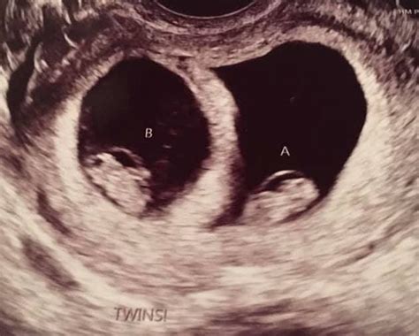 7 Weeks Pregnant with Twins - Twiniversity