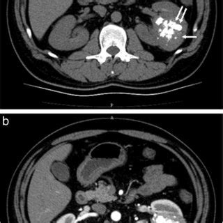 CT scan of the angiomyolipoma (AML) of the left kidney. (a) Noncontrast... | Download Scientific ...