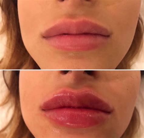 The Truth About Lip Fillers