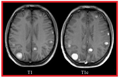 Comparison between a T1-Weighted MRI sequence without a contrast agent... | Download Scientific ...