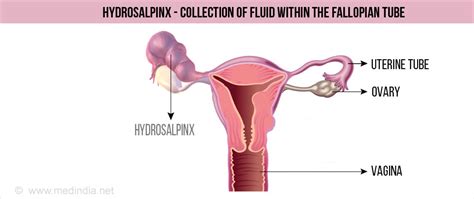 Salpingectomy - Types, Indications, Procedure, Complications