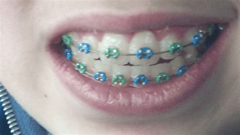 Colors in 2020 | Green braces, Cute braces colors, Braces colors