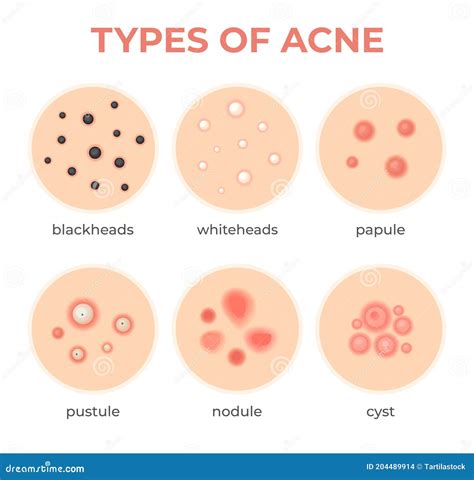 Acne Types. Skin Infection Problem, Pimples Grade and Type Cyst, Whitehead, Blackheads, Nodule ...