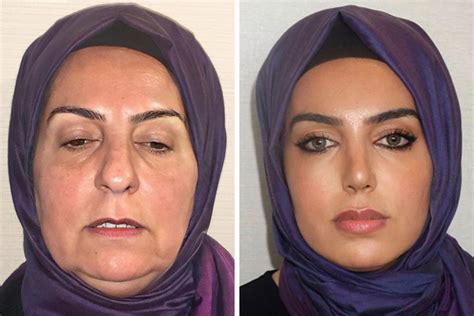 Before And After Photos From Turkish Plastic Surgery Clinic Have Left People Baffled | Bored Panda