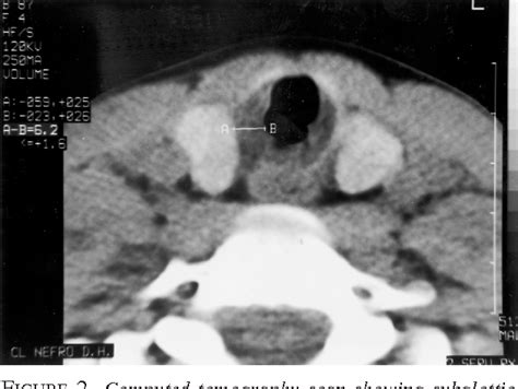 Idiopathic subglottic tracheal stenosis | Semantic Scholar