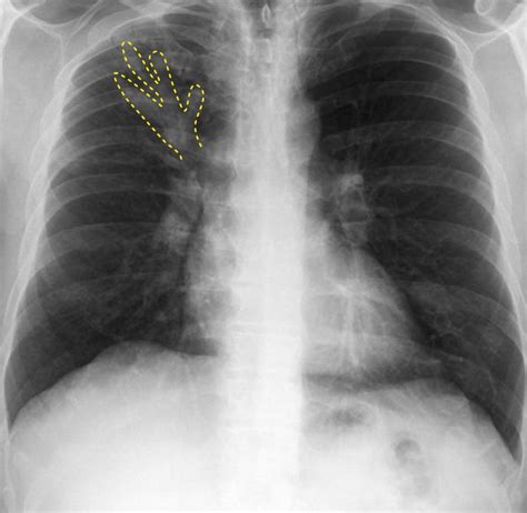 Allergic Bronchopulmonary Aspergillosis (ABPA) - Pulmonary - Medbullets ...