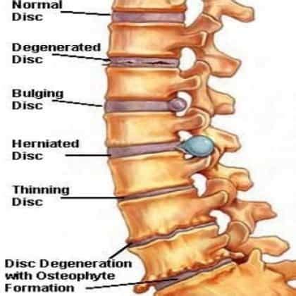 Herniated disc treatment L5-S1 with 3 exercises to avoid surgery