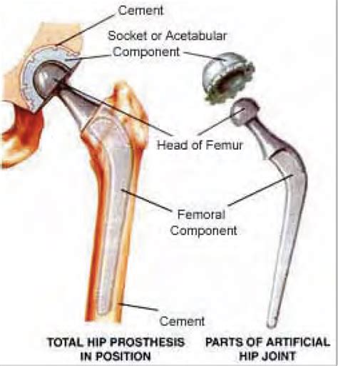 Total Hip Replacement Surgery at UPMC Sports Surgery Clinic