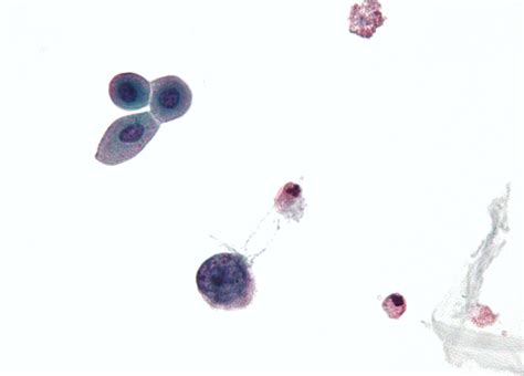 Test Microbiológico: Poliomavirus (BK Virus PCR) Análisis Clínicos y ...