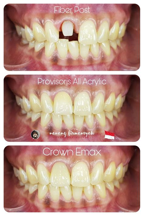 Emax Crown | Emax crowns, Teeth care, Dental clinic