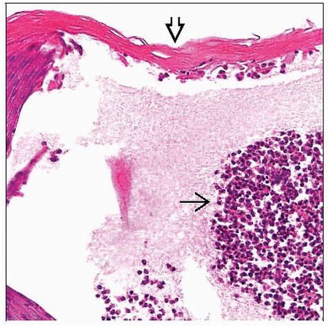 Transient Neonatal Pustular Melanosis | Basicmedical Key